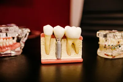 Understanding the Advantages and Disadvantages of Dental ImplantsIllustration